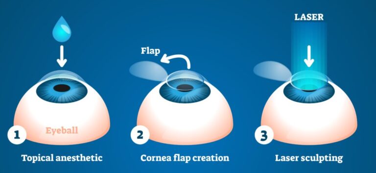 Corrective eye surgery vector illustration. Laser process education scheme.